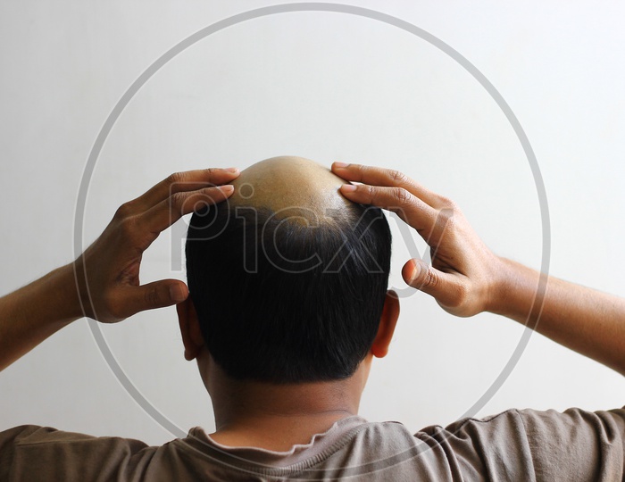 Bald Man In Isolated White Background Worried And Both Hands On His Scalp.View From Behind