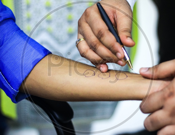 Skin Allergy Test Preparation By Doctor On A Patient Hand Using Allergy Sensitivity Kit