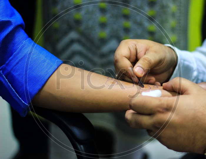 Skin Allergy Test Preparation By Doctor On A Patient Hand Using Lancet To Prick The Skin