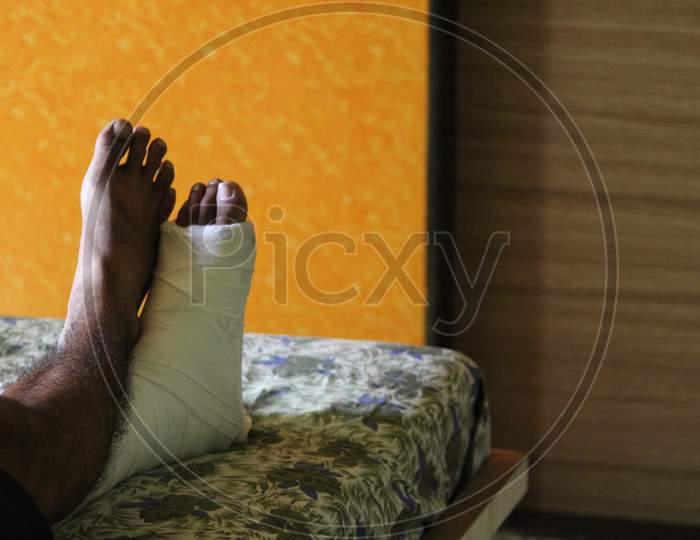 A Man Leg Fractured  Lying on Bed