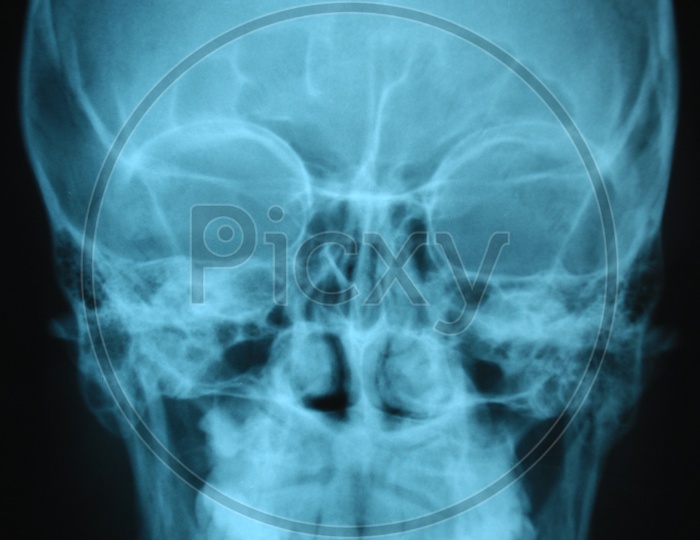 X Ray of Skull