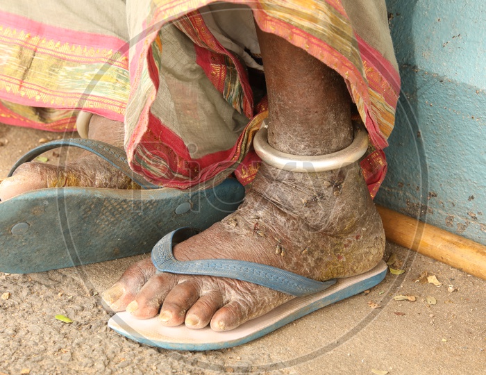 Leprosy Affected Leg Of a Beggar