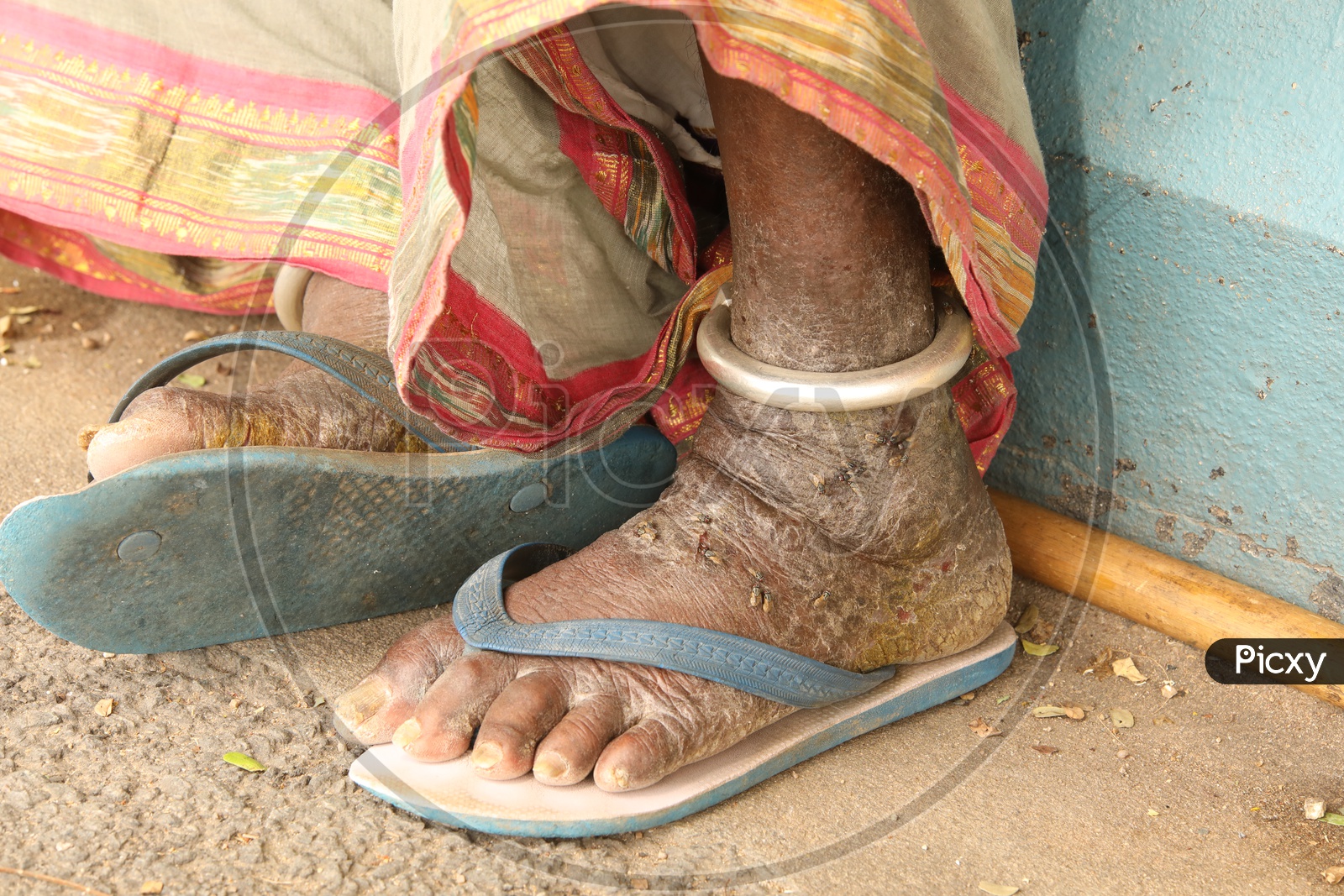 Leprosy Affected Leg Of a Beggar