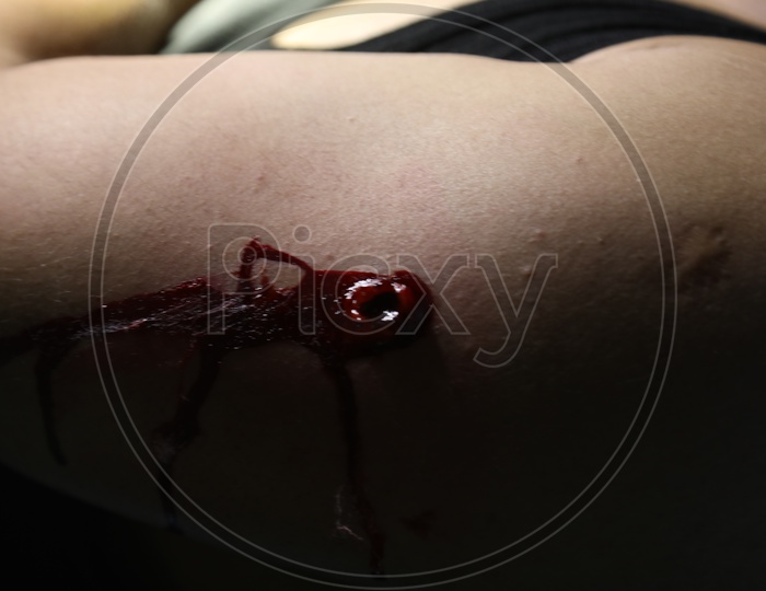 Bullet wound  Bleeding
