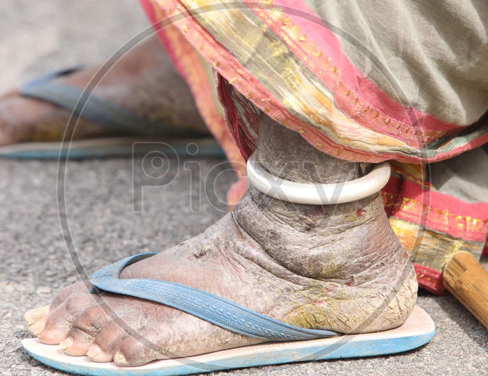 Leprosy Effected Leg Closeup