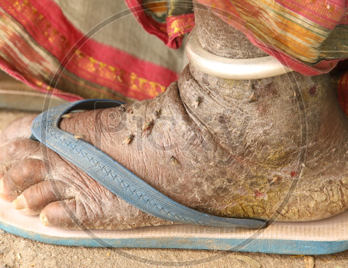 Leprosy Effected Leg Closeup