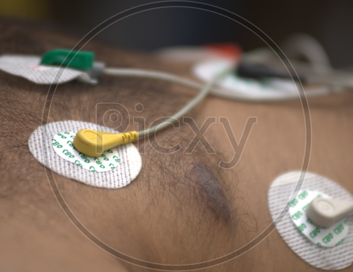 Patient with electrodes on chest