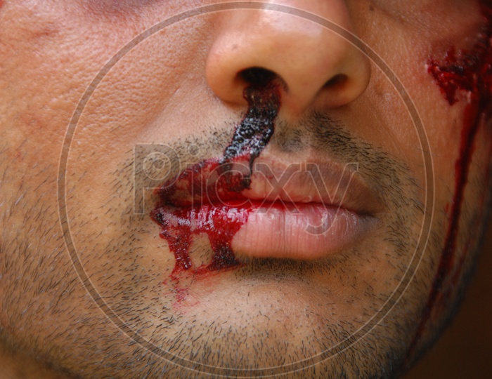 A man with injuries on his face