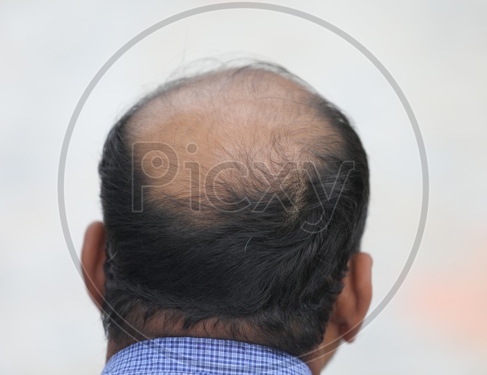 Bald head Hair Loss