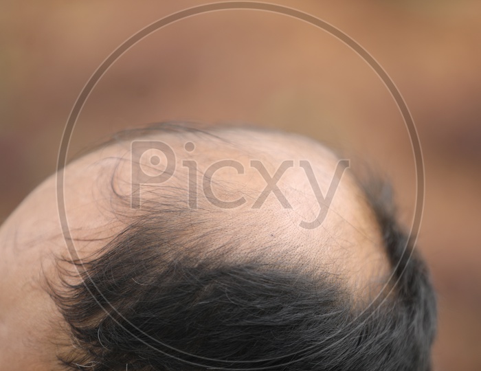 Bald head Hair Loss  Closeup