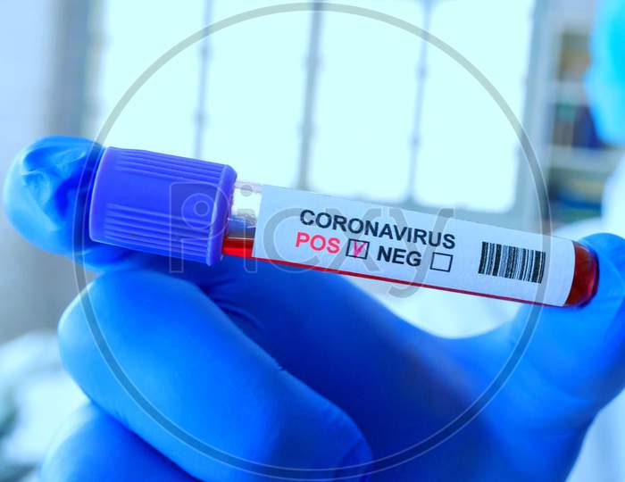 Corona Virus Blood Test In Hospital Laboratory