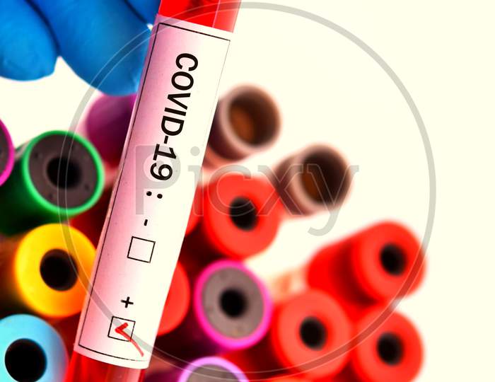 Blood Sample Tube Positive With Corona Virus 2019 Found In Wuhan, China