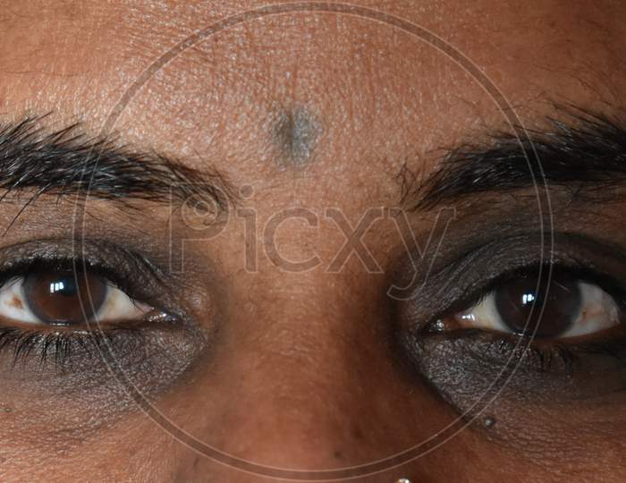 Dark circles around eyes of Indian women