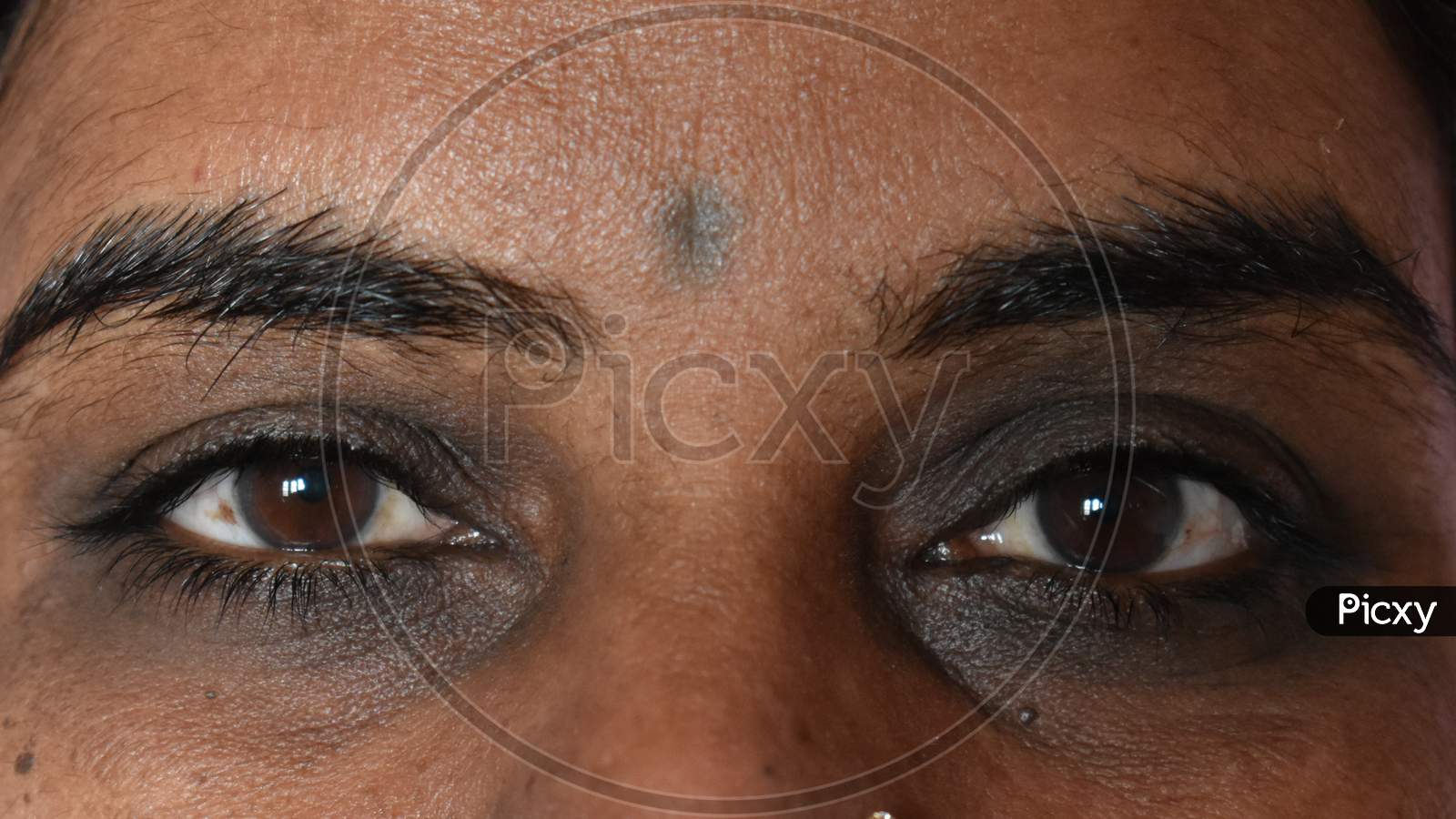 Dark circles around eyes of Indian women