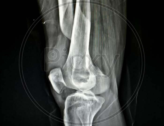 X-ray of fracture right thigh in 50 year old male