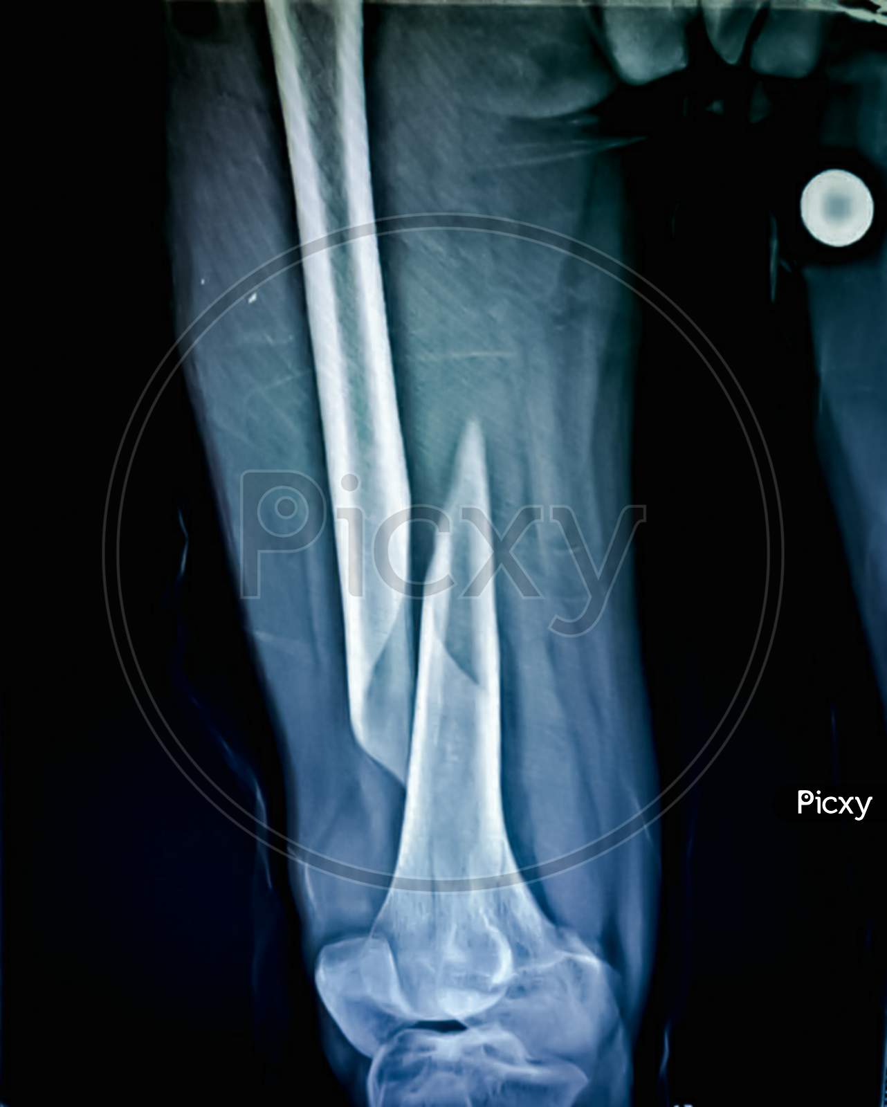 X-ray of fracture right thigh in 50 year old male