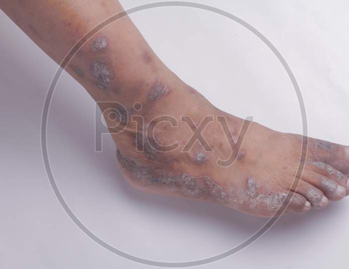 Closeup Of The Legs Of A Woman Suffering From Chronic Psoriasis On A White Background. Closeup Of Rash And Scaling On The Patient'S Skin. Dermatological Problems. Dry Skin. Isolated