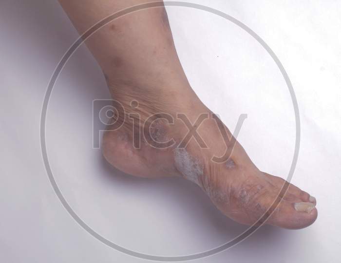 Closeup Of The Legs Of A Woman Suffering From Chronic Psoriasis On A White Background. Closeup Of Rash And Scaling On The Patient'S Skin. Dermatological Problems. Dry Skin. Isolated