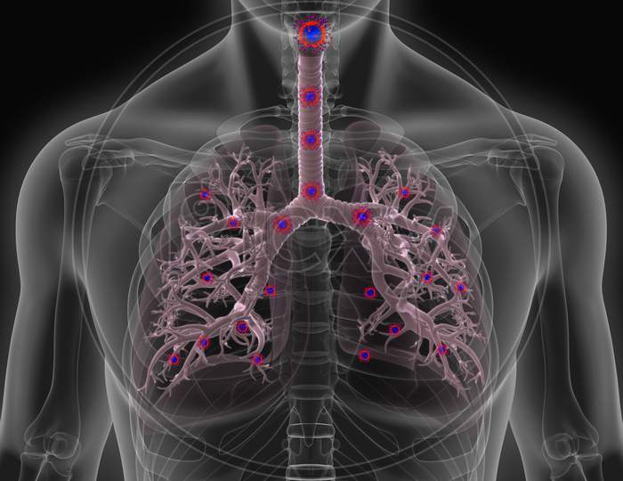 3D Illustration Human Lungs Infected With Corona Virus