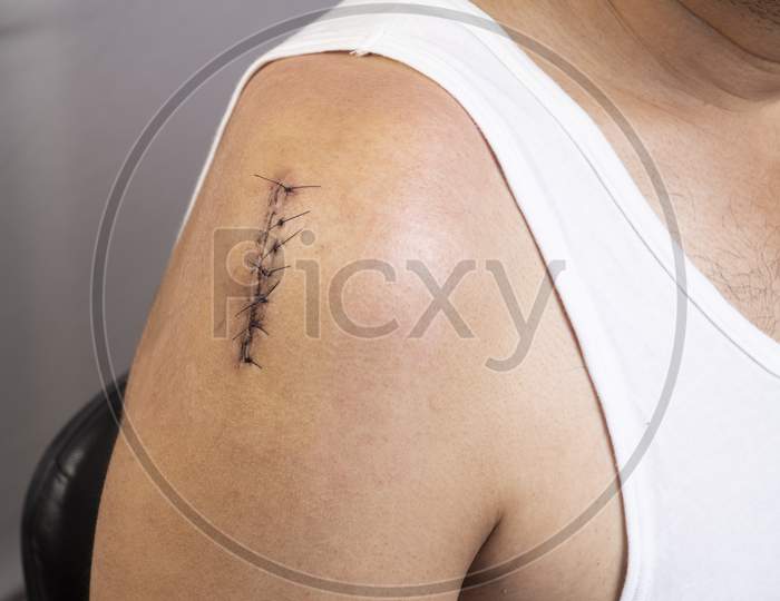 Front Side View Of Surgical Incision On Upper Right Shoulder Joint Closed With Sutures