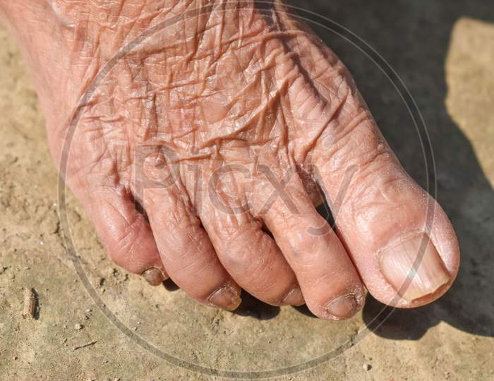 Fair Toe Of An Old Woman, Her Age Is More Than Eighty .