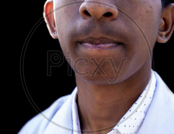 Close-Up Of Man Lips Suffering From Herpes Disease.