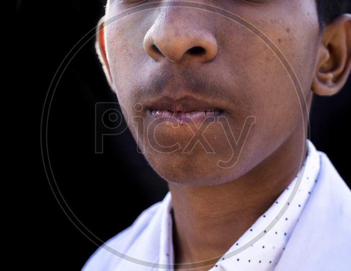 Close-Up Of Man Lips Suffering From Herpes Disease.