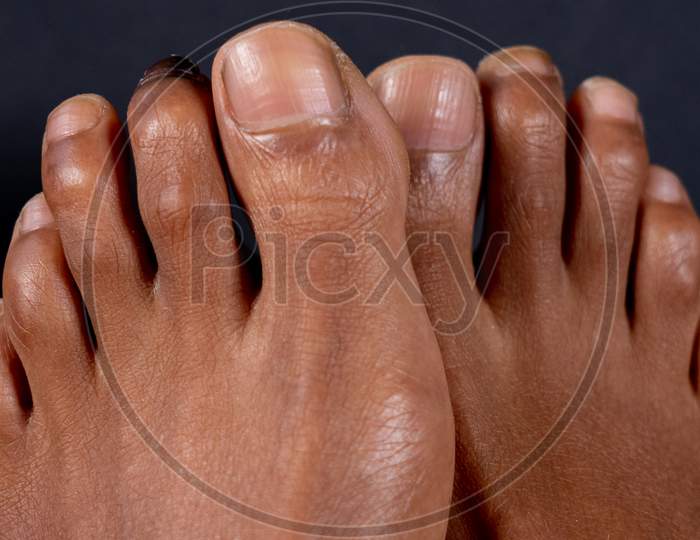 Hammer toe on the second toe of a mixed-race woman in front of black background.