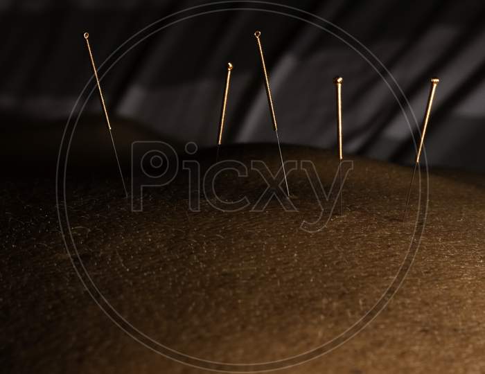 Acupuncture Needles For Treatment Using Chinese Medicine. Acupuncture On The Back For Pain In The Lumbar Region.