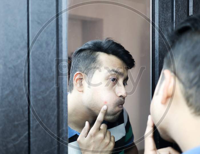 A Man Squeezing His Pimple In His Cheek In Front Of A Mirror. Acne Treatment Concept Image