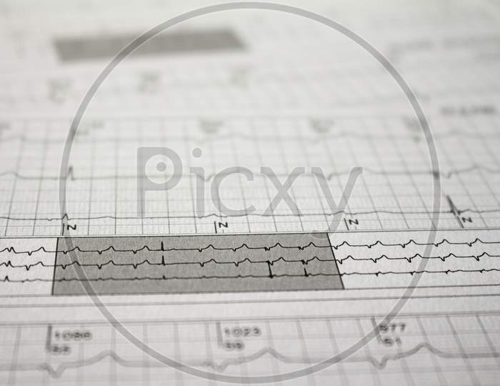 Three-Channel Holter Ekg Strip Showing Heartbeat Waves. Electrical Activity Of The Heart Recorded On Paper.
