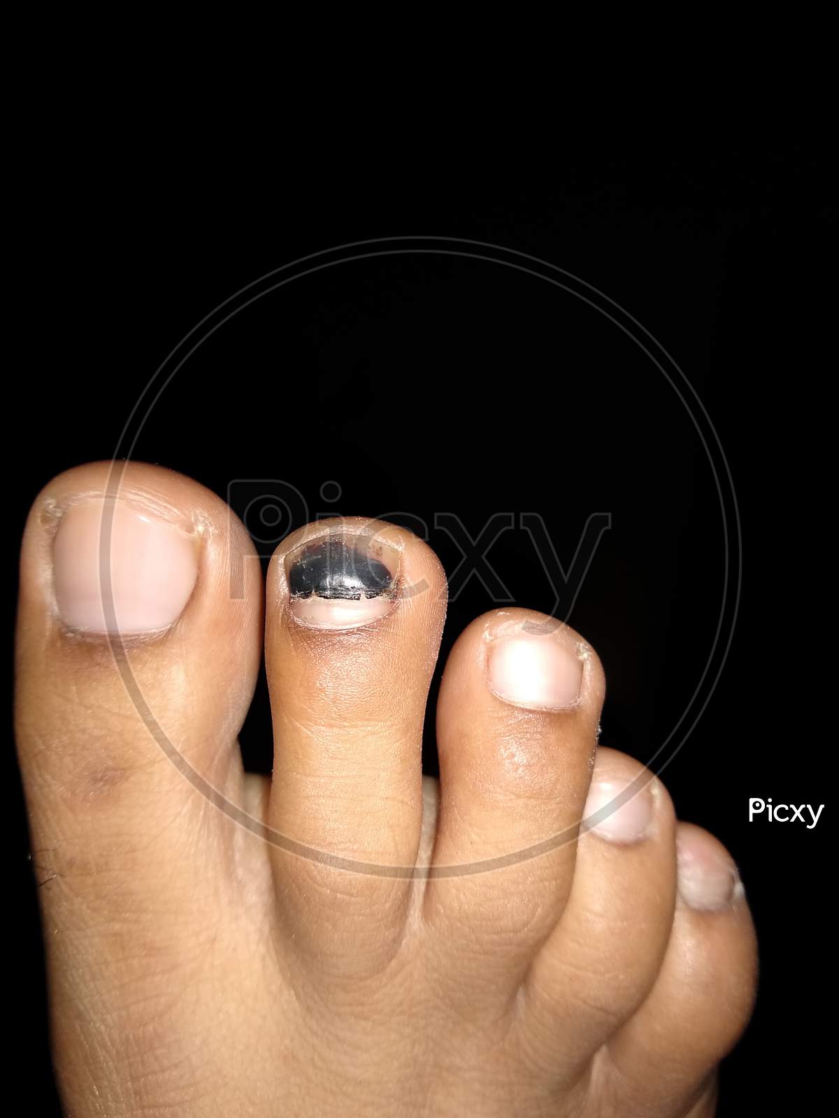 Close up view of cracked and black bruise index toe nail isolated on black background. Human foot with black bruise toe nail