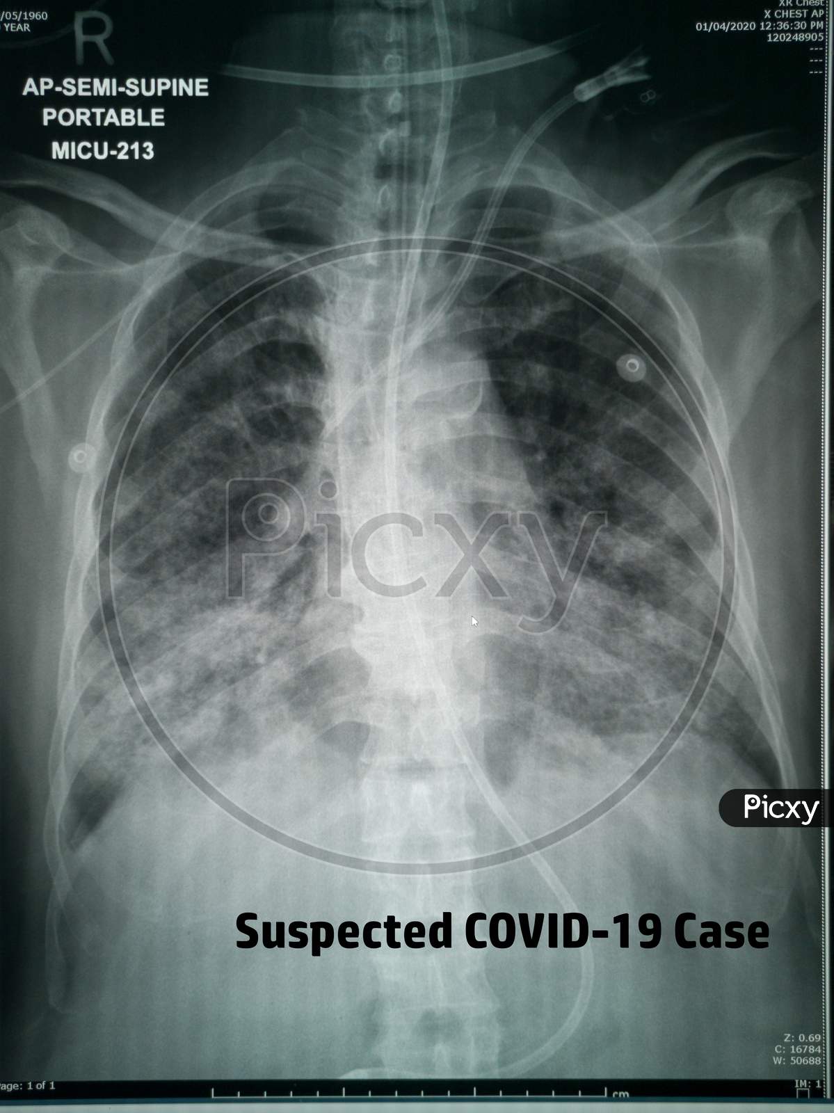 Chest X-Ray of suspected Corona virus patient high quality image showing changes in the lung due to Covid-19 virus with chest tubes