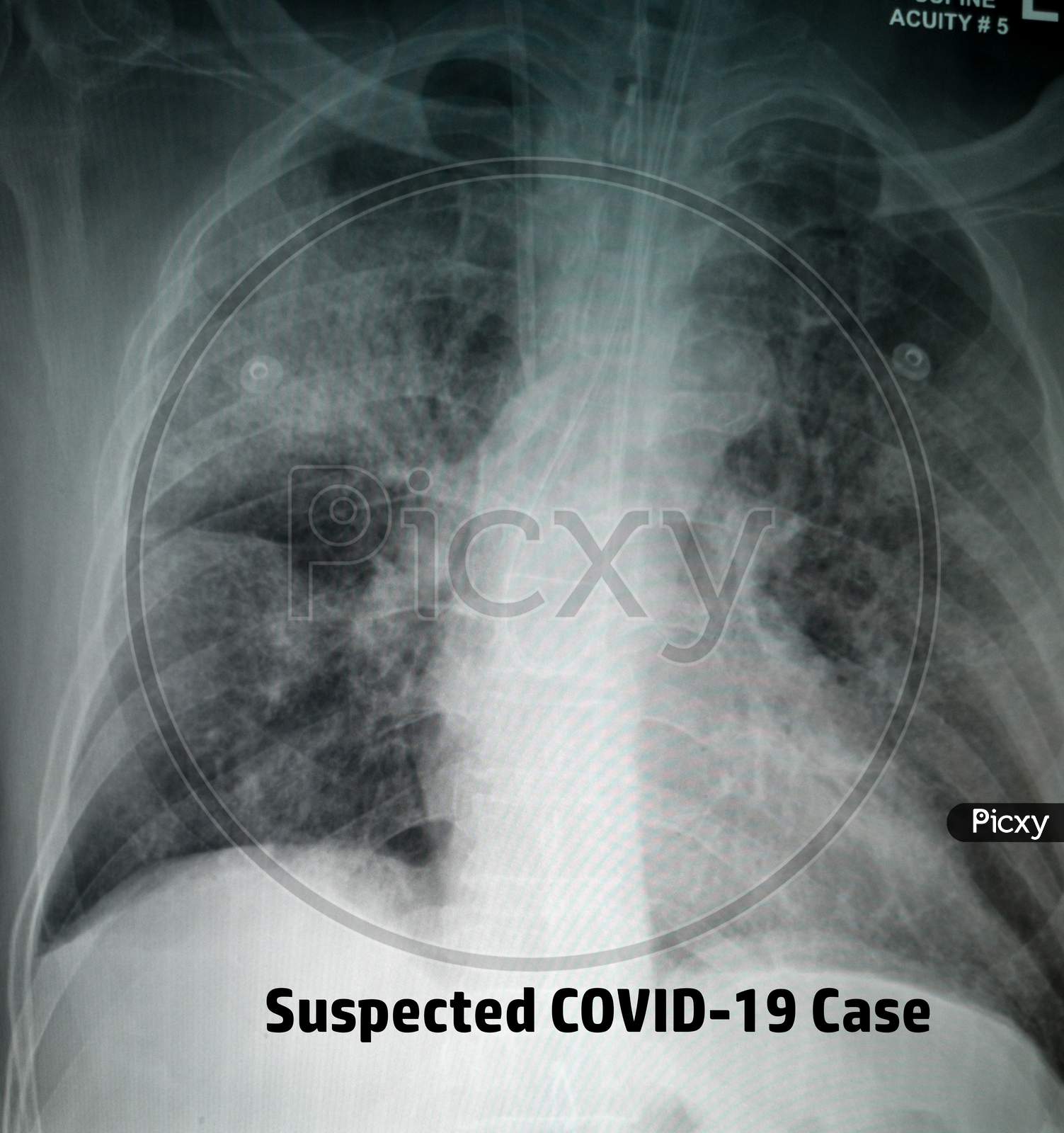 Chest X-Ray of suspected Corona virus patient high quality image showing changes in the lung due to Covid-19 virus with chest tubes