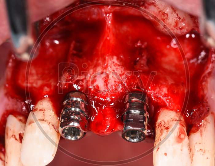 A Close Up Image Of An Adults Upper Central Incisor Teeth Surgery Implants (Teeth Number 11 And 21)