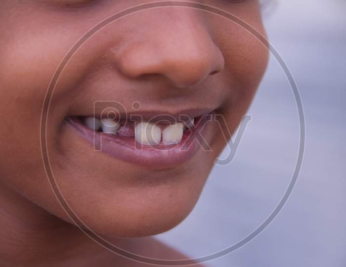 Broken Teeth Girl Happy Open Smiling