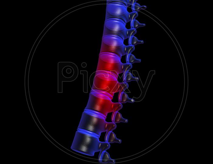 3D Painful Spine