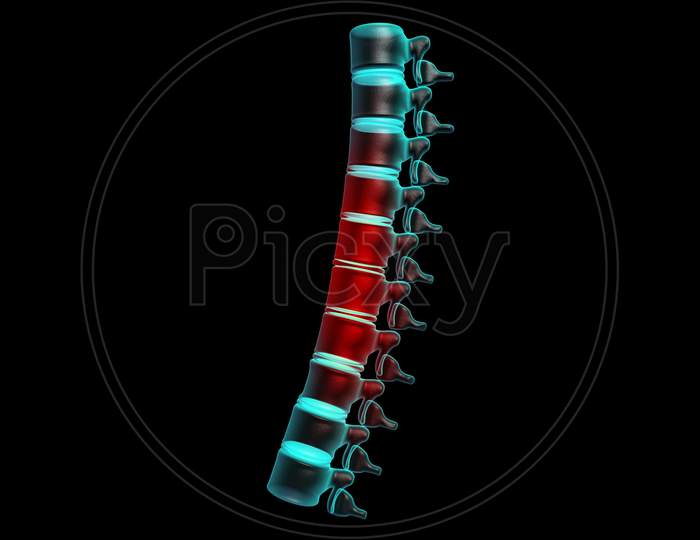 3D Painful Spine