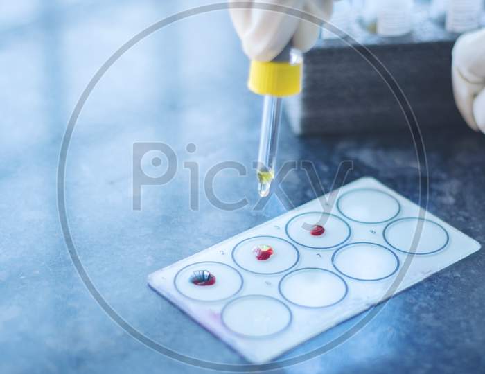 Close Up, Hands Testing Blood Group Called Protocol Of Abo Blood Grouping Or Testing, Adding Antisera To The Blood Drops On Glass Slide.
