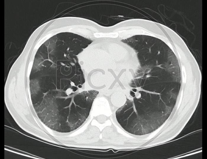 Computed Tomography of the chest (high resolution CT chest)   in a confirmed case of COVID-19 (Corona virus) showing changes in both lungs with ground glass capacities