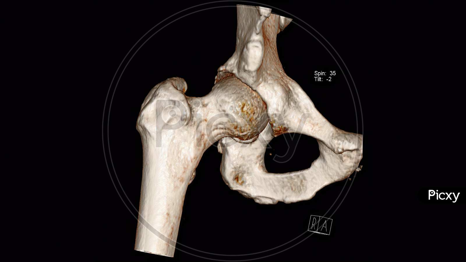 Radiology examination, Computed Tomography Volume Rendering examination of the  Hip joint ( CT VR Hip)