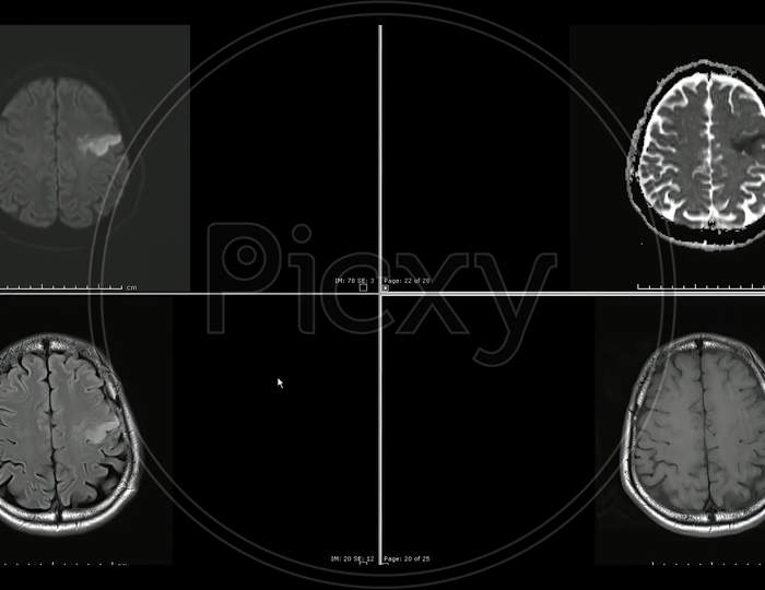Magnetic resonance  images (MRI) of brain infarction  in the left frontal lobe superior cuts