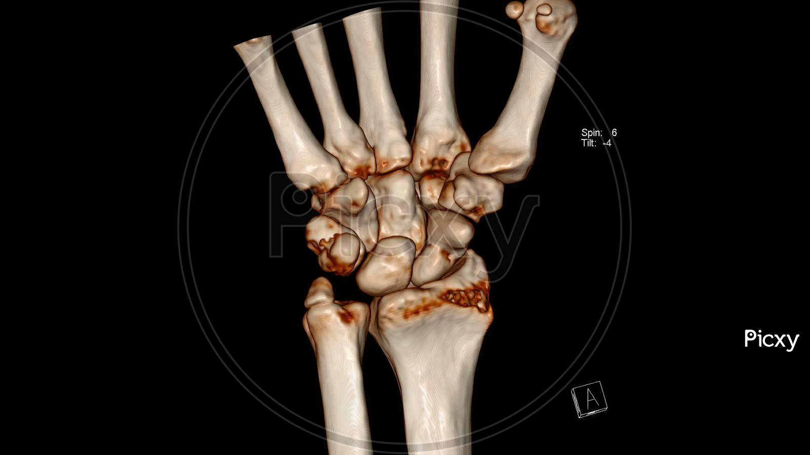 Radiology examination, Computed Tomography Volume Rendering examination of the wrist joint ( CT VR wrist) showing fracture of the scaphoid bone and ulnar styloid process