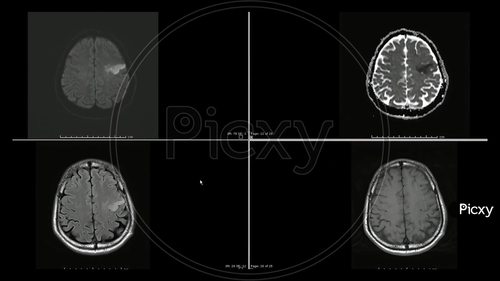 Image Of Magnetic Resonance Images Mri Of Brain Infarction In The Left Frontal Lobe Superior Cuts Qb Picxy