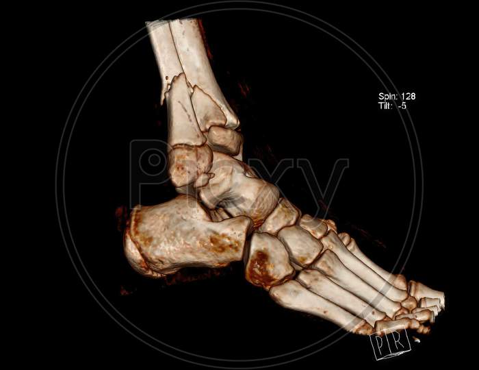 Computed Tomography volume rendering image (CT VR)  of fracture of the leg bones (Tibia and fibula) above the ankle