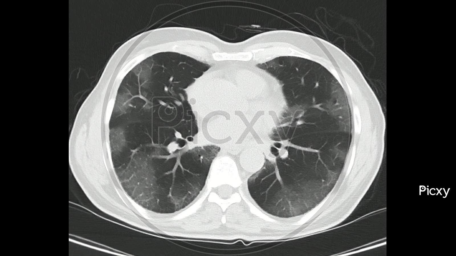 Computed Tomography of the chest (high resolution CT chest)   in a confirmed case of COVID-19 (Corona virus) showing changes in both lungs with ground glass capacities