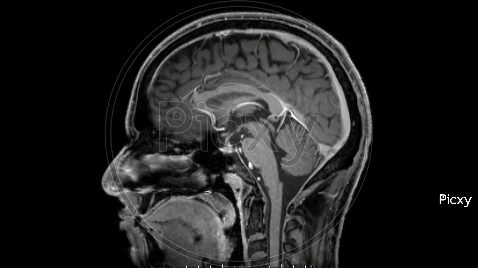 Image Of Magnetic Resonance Images Of The Brain Mri Brain Sagittal Post Contrast Sequence Be Picxy