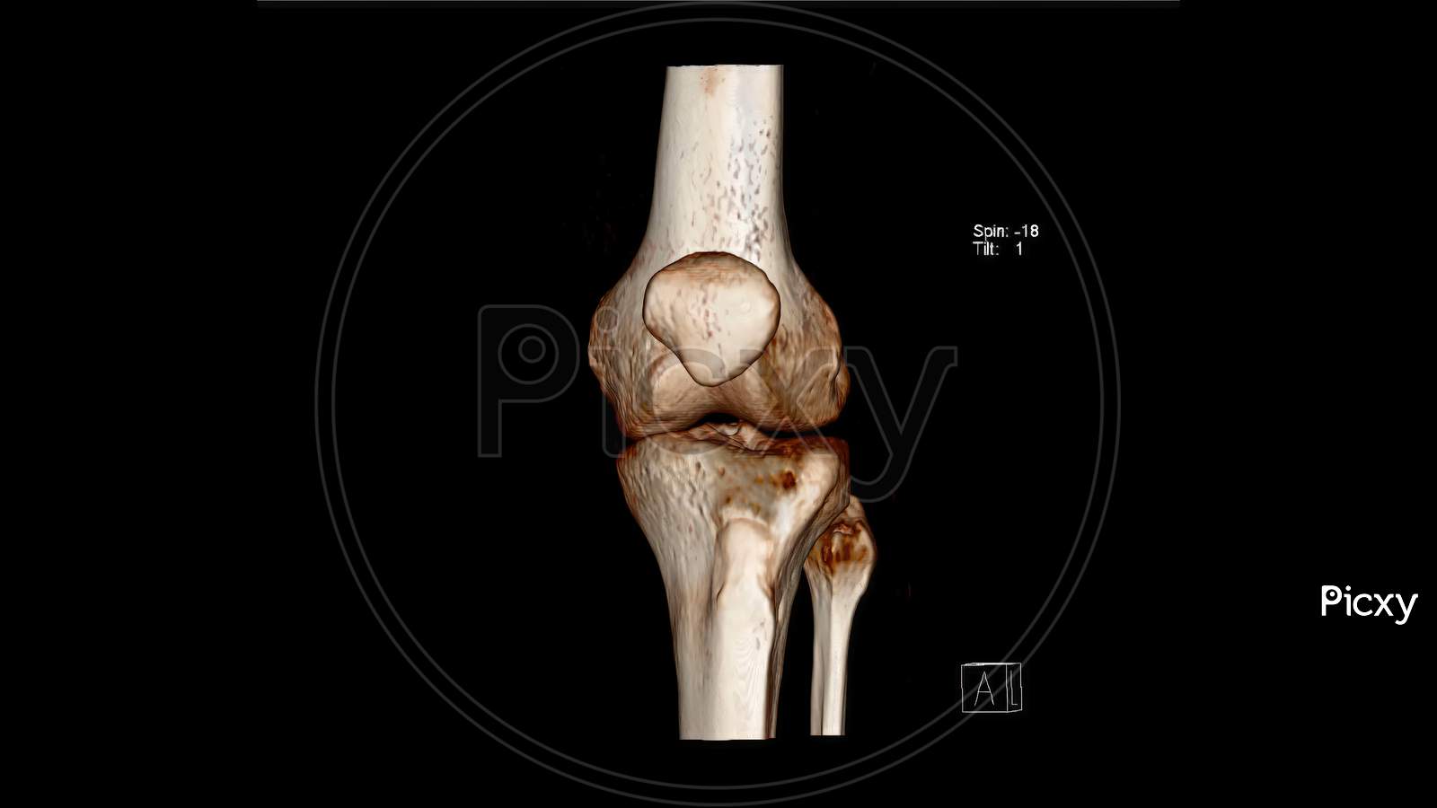 Computed Tomography Volume Rendering examination of the Knee joint