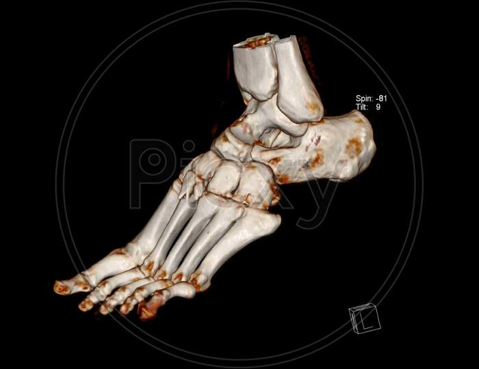 Computed Tomography Volume Rendering examination of the Foot