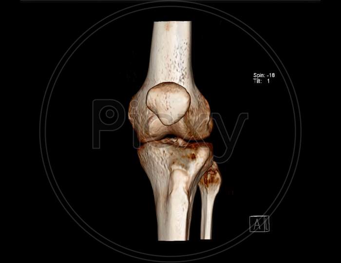 Computed Tomography Volume Rendering examination of the Knee joint